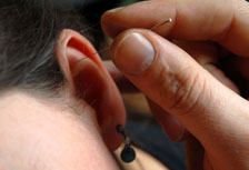 Auricular Acupuncture