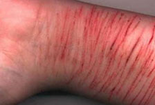 Cutting Addiction Treatment